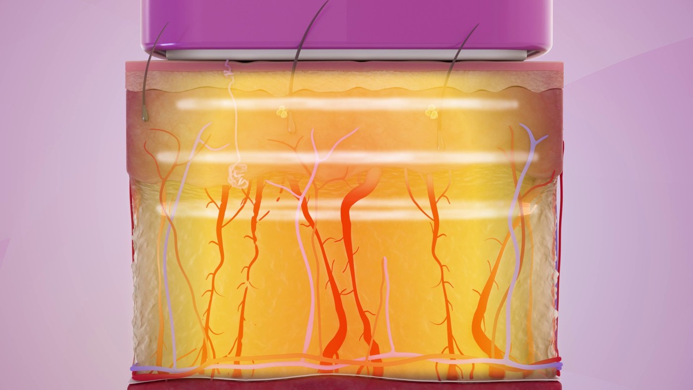 Thermage FLX official illustration, Beauty Z Skin Clinic Myeongdong